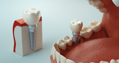 Implants Dentaires