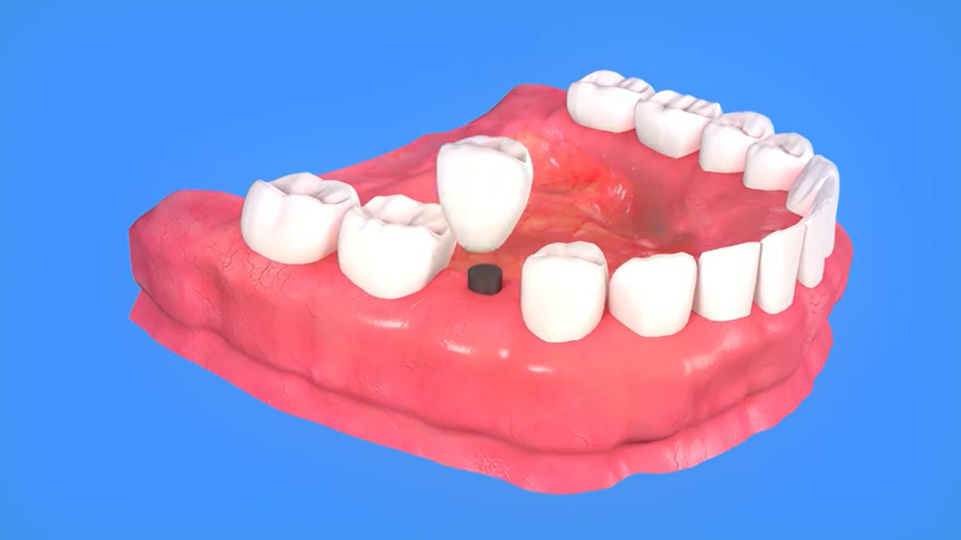 Implant dentaire immédiat