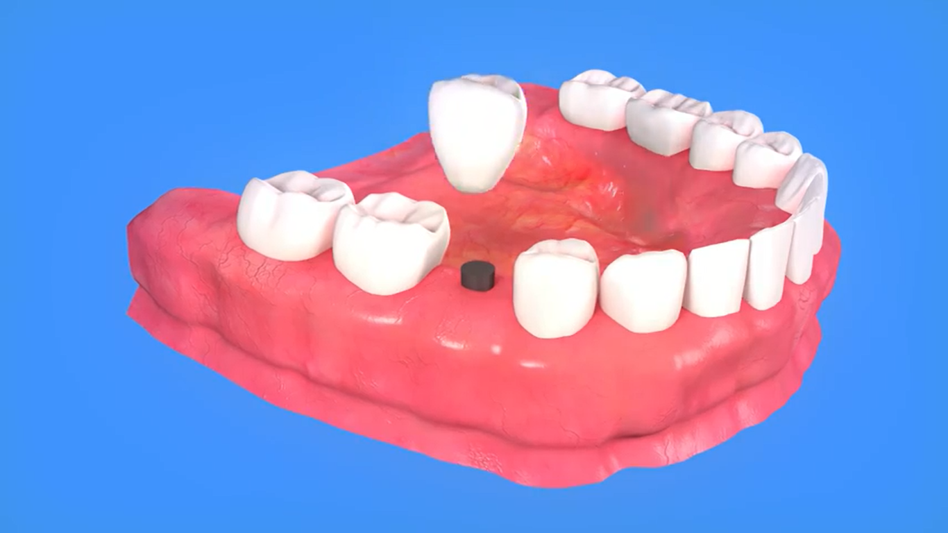 implant dentaire unitaire