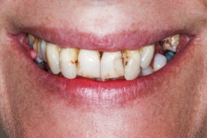 Implants dentaires pour la bouche complète