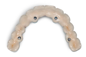 Couronnes sur implants
