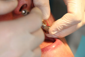 Extraction des dents