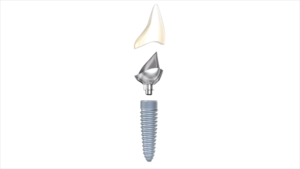 Implants Dentaires  Implant dentaire, clinique à l'étranger