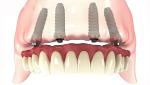 Dents dans la journée, implant dentaire