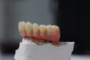 Bridge dentaire sur implants