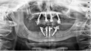 les implants dentaires
