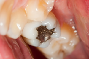 Restauration de dents en amalgame 