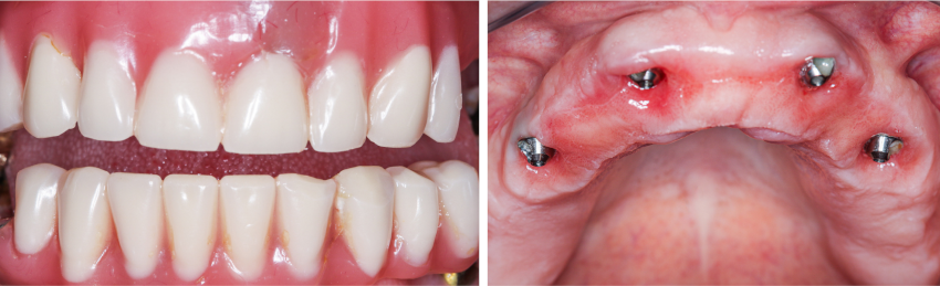 All on 4 implant dentaire