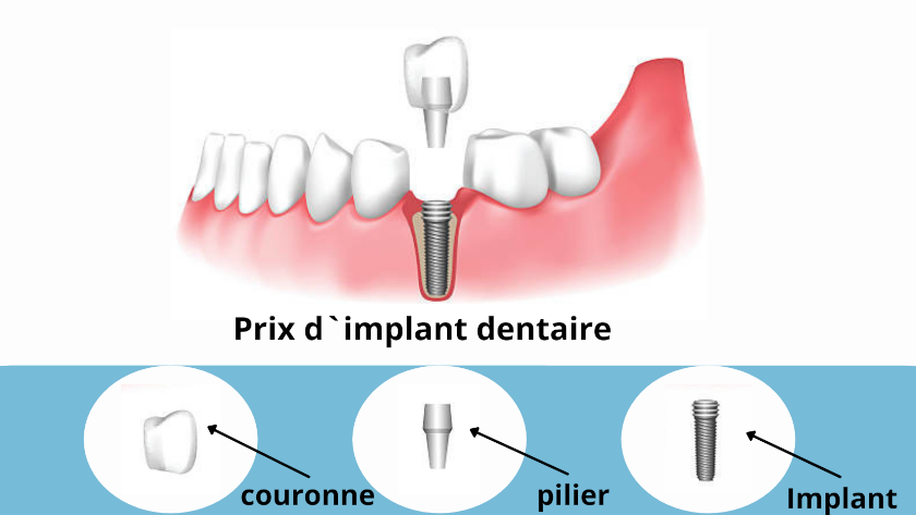 Prix d`implant dentaire
