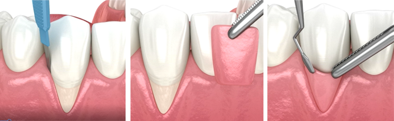 La récession gingivale