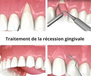 la rétractation gingivale